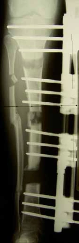 Po dvou osteotomiích
tibie a zahájení segmentálního
bifokálního transportu