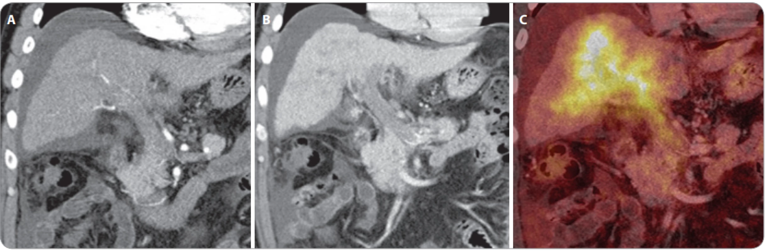 A–C. Vyšetření PET/CT s podáním 18F-fl uorodeoxyglukózy u špatně diferencovaného karcinomu, který vznikl v terénu jaterní
cirhózy, ve vena portae hepatis se vyskytuje nádorový trombus, který vykazuje podobně jako nádor vysokou úroveň glykolýzy.
Kolem jater je přítomen ascites. 