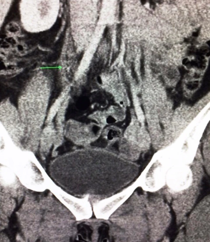 CECT 12 weeks after delivery: complete recanalization of
right ovarian vein (green mark)