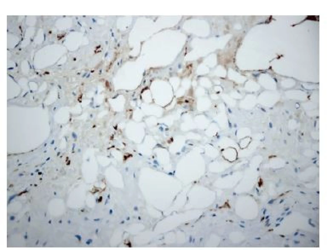 Fokální silná jaderná imunohistochemická
pozitivita markeru S 100 v adipocytech ložiska fibrolipomatózní
metaplazie (400×)<br>
Fig. 2. Strong focal nuclear S100 immunohistochemical
positivity in adipocytes of the metaplastic fibrolipomatous
tissue (×400)