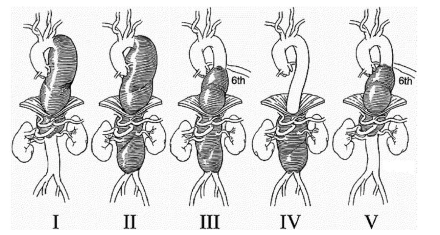 Modifikovaná klasifikace TAAA podle Crawforda<br>
Fig. 1: Modified TAAA Crawford classification