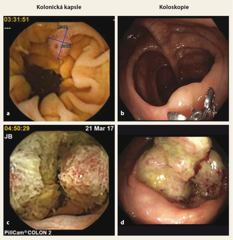 Porovnání nálezů na kolonické kapsli a optické kolonoskopii (a + b polyp,
c + d karcinom). Zdroj: archiv Oddělení gastrointestinální endoskopie ÚVN
Praha.<br>
Fig. 2. Comparison of lesions found on capsule endoscopy and optical colonoscopy
(a + b polyp, c + d cancer). Source: Department of Gastrointestinal Endoscopy of
Military University Hospital, Prague.