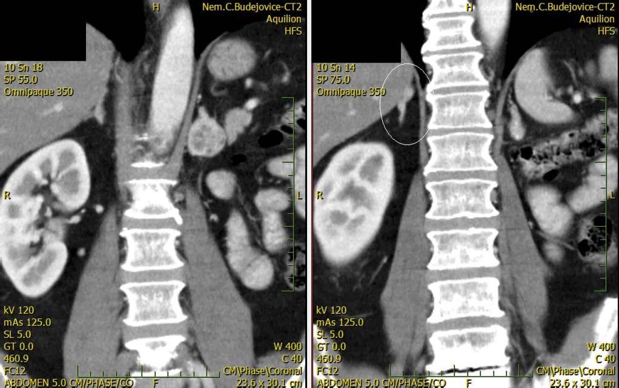 CT zobrazující bilaterální metastázy nadledvin<br>
Fig. 2. CT scan showing bilateral adrenal metastaseis