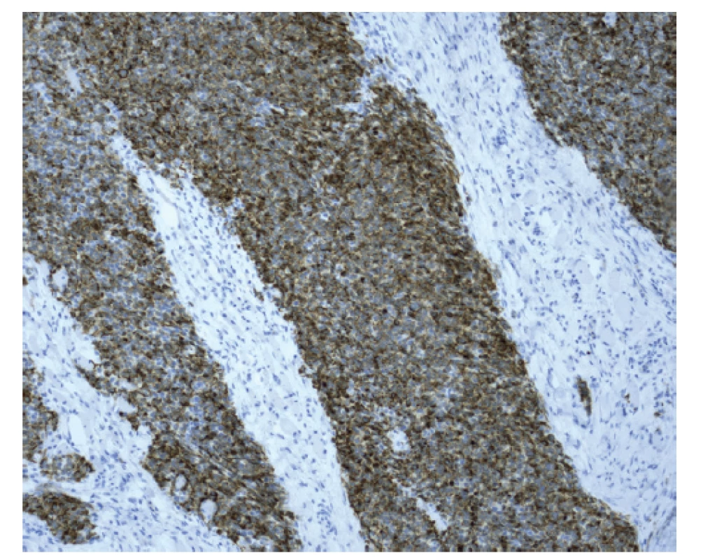 Prokázaná přítomnost epiteliální složky pomocí
cytokeratinového koktejlu CKAE1/AE3.<br>
Fig. 10: Verification of the epithelial component using the
CKAE1/AE3 cytokeratin cocktail.