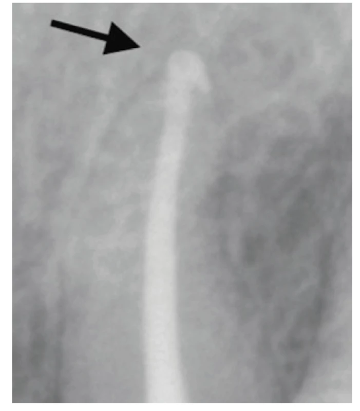 Kontrolní RTG snímek po deseti měsících s viditelným náznakem hojení v apikální oblasti <br>
Fig. 12 Control X-ray after ten months with visible sign of healing in the apical area