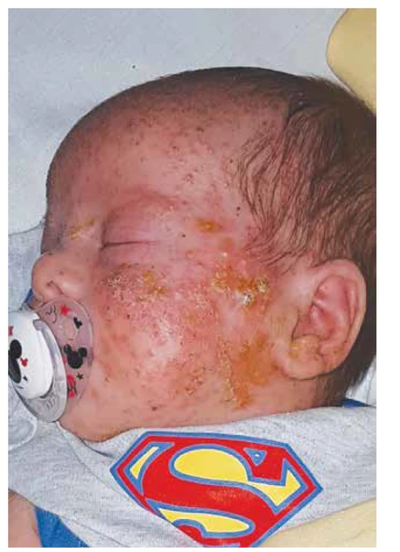 AD hyper-IgE syndrom, folikulární papulopustulóza
v kojeneckém věku.<br>
Fig. 4. AD hyper-IgE syndrome, follicular papulopustulosis in
infancy.