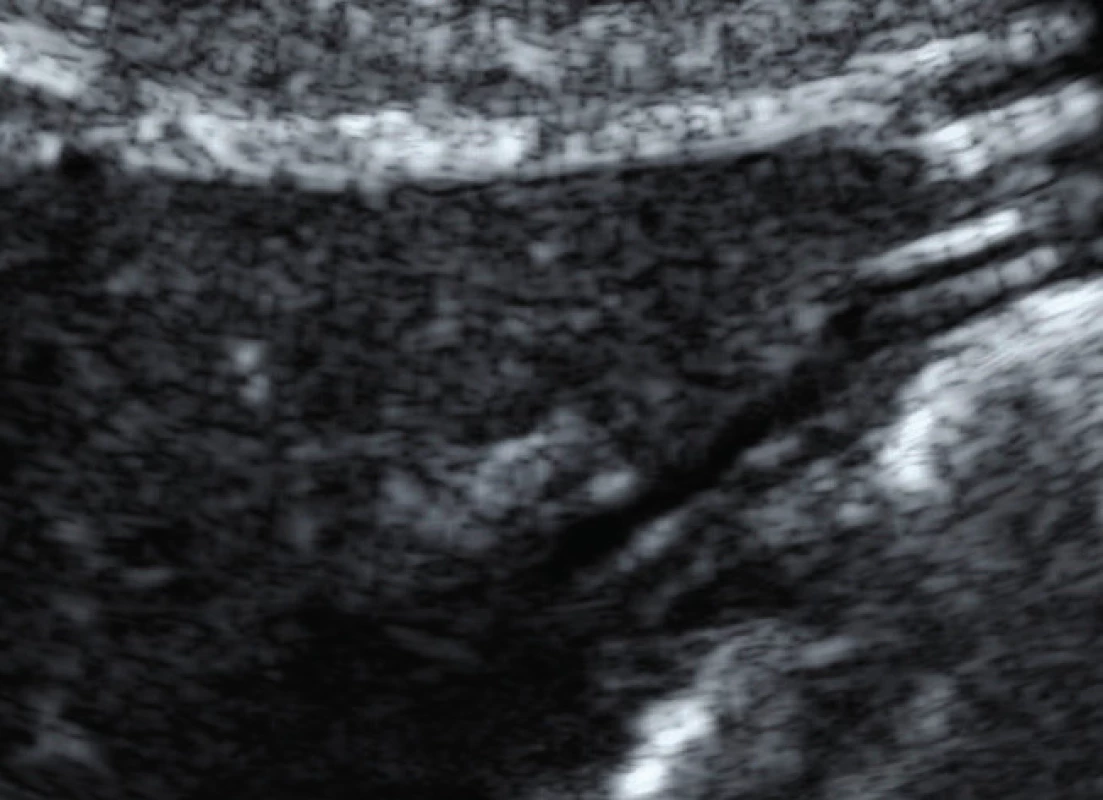 Ultrasound image of ruptured implant
