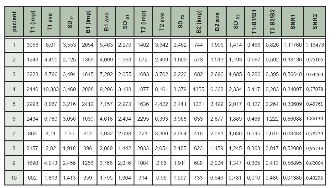 Tabulka naměřených hodnot – hodnoty s indexem 1 časný scintigram, index 2 pozdní scintigram. T (imp) – počet naměřených impulzů
v oblasti cílové léze, T ave – průměrný počet impulzů na pixel v oblasti cílové léze, SDT – směrodatná odchylka v oblasti cílové léze,
B (imp) – počet naměřených impulzů v oblasti pozadí, B ave – průměrný počet impulzů na pixel v oblasti pozadí, SDB – směrodatná odchylka
v oblasti pozadí, T-B/B – kontrast ložiska, SNR – poměr signálu a šumu ložiska.