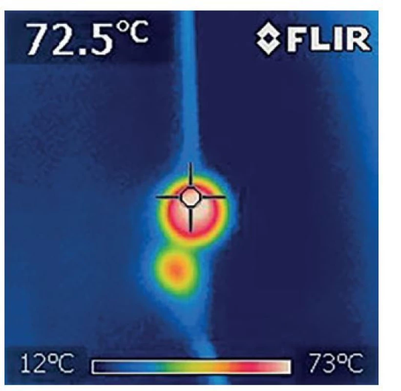 Absorpce laserového paprsku na hrotu světlovodu
v želatině zobrazena termokamerou – srovnání vlnové
délky 1470 a 1940 nm<br>
V experimentu je patrná menší penetrace laserového paprsku
DL 1940 nm (dolní paprsek).<br>
Fig. 1: Laser beam absorption in jelly visualized by thermal
camera – comparison of the wavelengths 1470 nm
and 1940 nm<br>
The experiment demonstrated a lower penetration rate of DL
1940 nm (the lower beam).