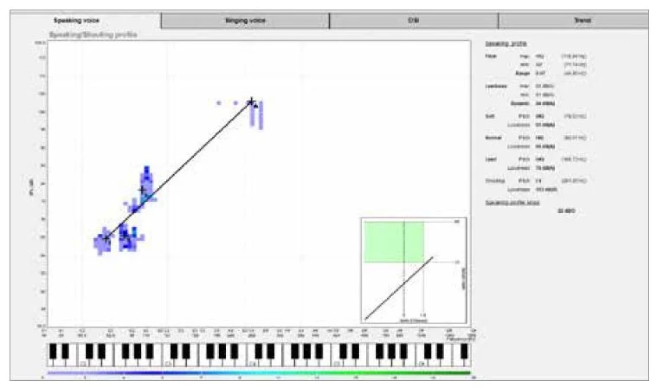 a. Hlasová analýza – vstupní vyšetření.<br>
Fig. 2a. Voice analysis – entry examination.