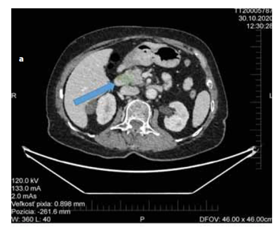 a) CT abdomenu s nálezom Tu pankreasu bez regionálnej
lymfadenopatie.<br>
Fig. 1a) Abdominal CT with pancreatic cancer without sign of
regional lymphadenopathy.