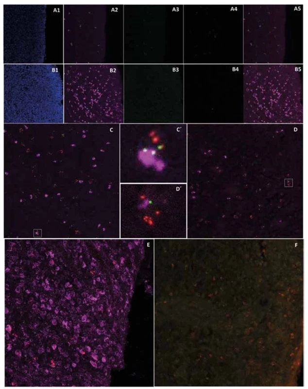 Immunofluorescent detection of pan-cytokeratin, cytokeratin 14 and macrophages in post-CED defects of animals
L139 and T61<br>
Expression of pan-cytokeratin in post-CED defect submucosa close to cicatricial mucosa of animal L139 (A2, 5, purple) and T61
(B2, 5, purple) (A1, B1 – DAPI channel; A3, B3 – pOKs, green; A4, B4 – MSCs, red; A5, B5 – merge of A2, 3, 4 or B2, 3, 4 channels; 400x
magnification). Expression of pan-cytokeratin (purple) and its co-localization with pOKs/MSCs aggregates in submucosa of animal
L139 ESD site (C, C´, 400x magnification). Expression of cytokeratin 14 (purple) and its co-localization with pOKs/MSCs aggregates
in submucosa of animal L139 post-CED defect. (D, D´, 400x magnification). Expression of macrophage marker (purple) in post-CED
defect site submucosa close to cicatricial mucosa of animal L139 (E) and T61 (F, almost negative) (pOKs – green, MSCs – red, 400x
magnification).