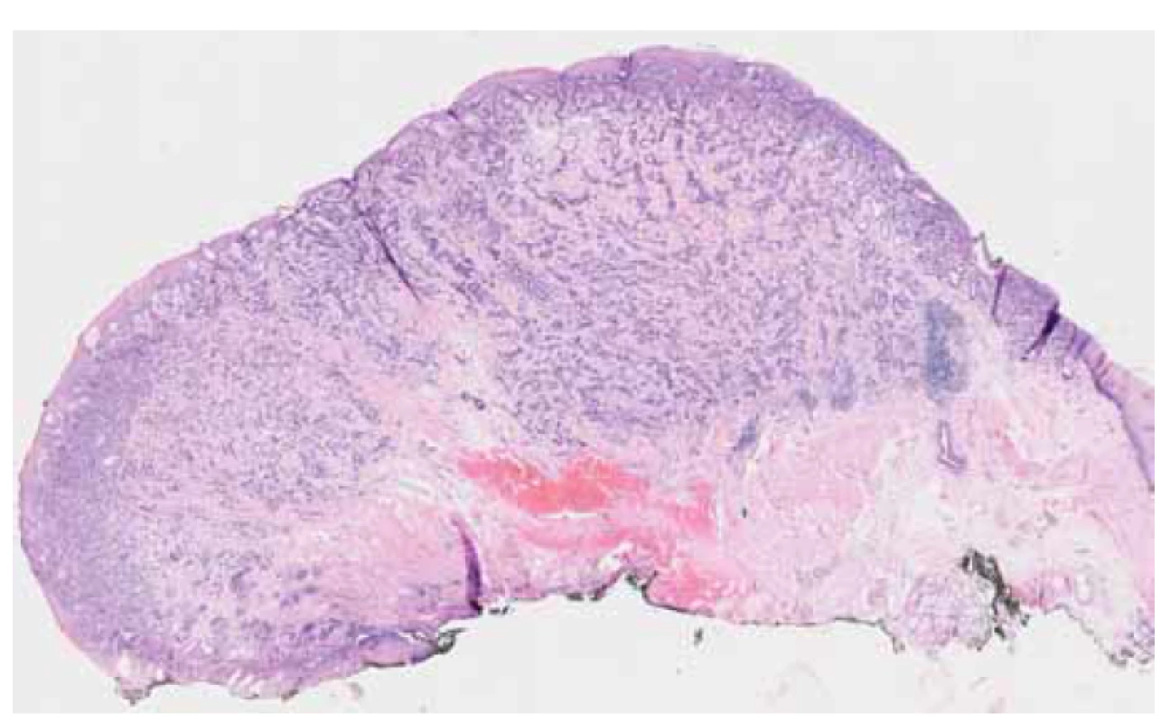 Histologické zobrazení preparátu po EMR. Fotografie pořízená Ústavem
klinické a molekulární patologie FN Olomouc, MUDr. Daniela Skanderová.<br>
Fig. 5. Histological imaging of the specimen after EMR. Photograph taken by the
Institute of Clinical and Molecular Pathology, Olomouc University Hospital, Daniela
Skanderová, MD.
