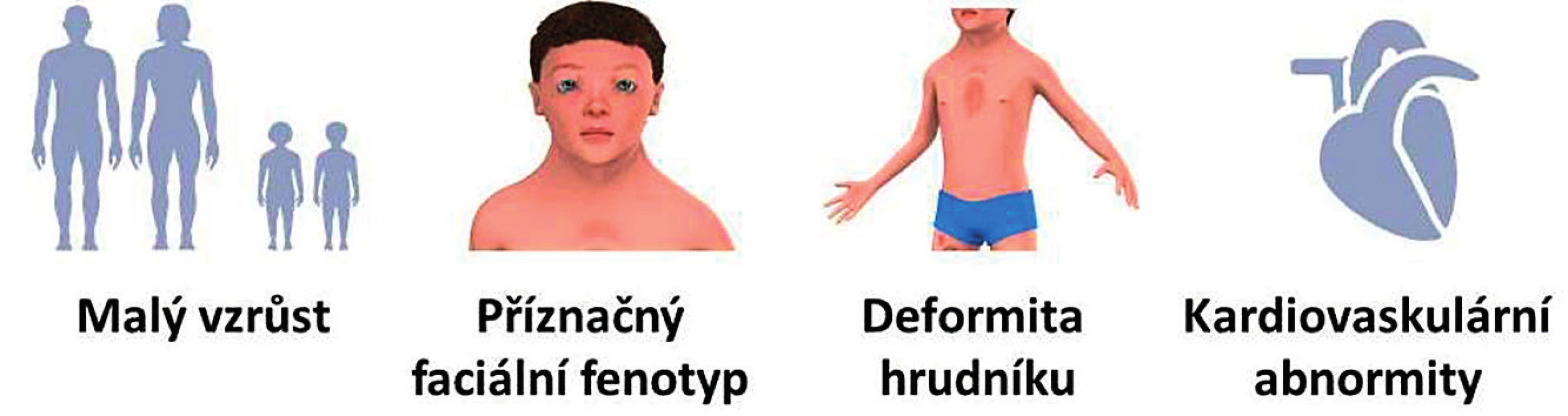 Hlavní klinické příznaky RASopatií/syndromu Noonanové.<br>
Fig. 1. Major clinical signs of RASopathies/Noonan syndrome.
