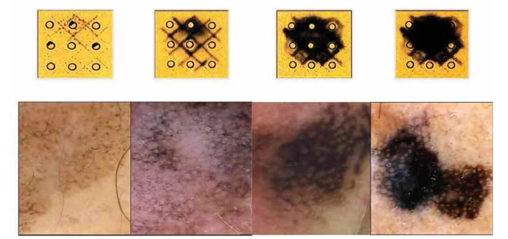 Schématický model dermatoskopických obrazů růstové progrese lentigo maligna v lentigo maligna melanoma
Asymetricky pigmentovaná folikulární ústí, anulárně-granulární struktura, rhomboidní obrazce, difuzní pigmentace překrývající
ústí folikulů. Šedé zbarvení jednotlivých struktur u časných forem nádoru.