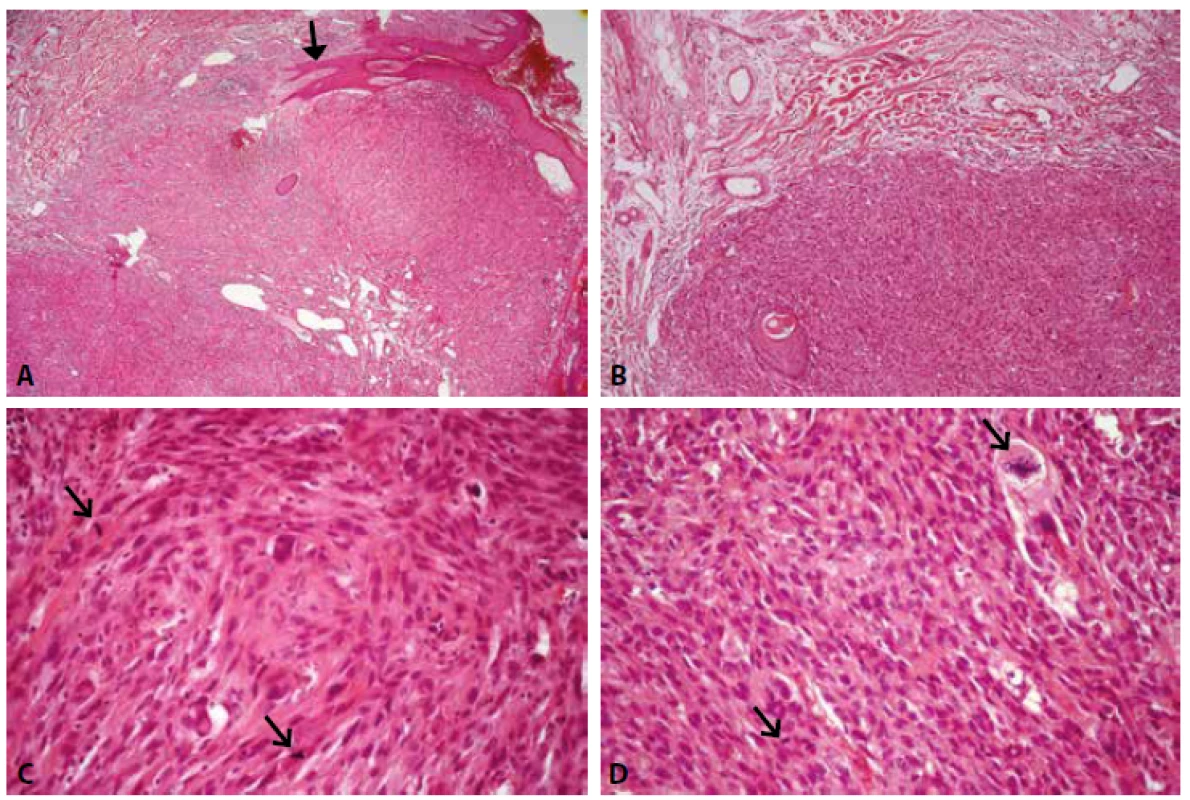 Histological appearence of atypical fibroxanthoma. A. Tumor localized in dermis, surface epithelium forms collar-shaped rim around the
tumor (arrow). B. The border between tumor and subcutaneous tissue is sharp. C, D. Tumor is composed predominantly of spindle-shaped cells
with pleomorphic nuclei and multiple mitoses including atypical mitotic figures (arrows). HE, original magnification x40, x100, x400, x400.