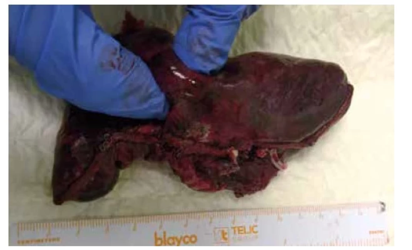 Robotické segmentektomie S1a+2 vpravo pro
15mm adenokarcinom při hranici S2 a S1, preparát<br>
Fig. 2: Robotic segmentectomy S1a+2 right for 15 mm
adenocarcinoma at the border of S2 and S1, specimen
