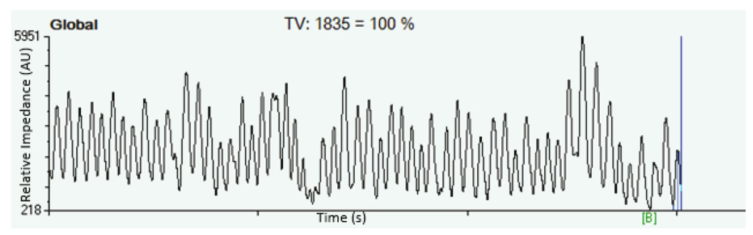 Change of impedance representing the spontaneous breathing of one subject – calibrated EIT measurement.