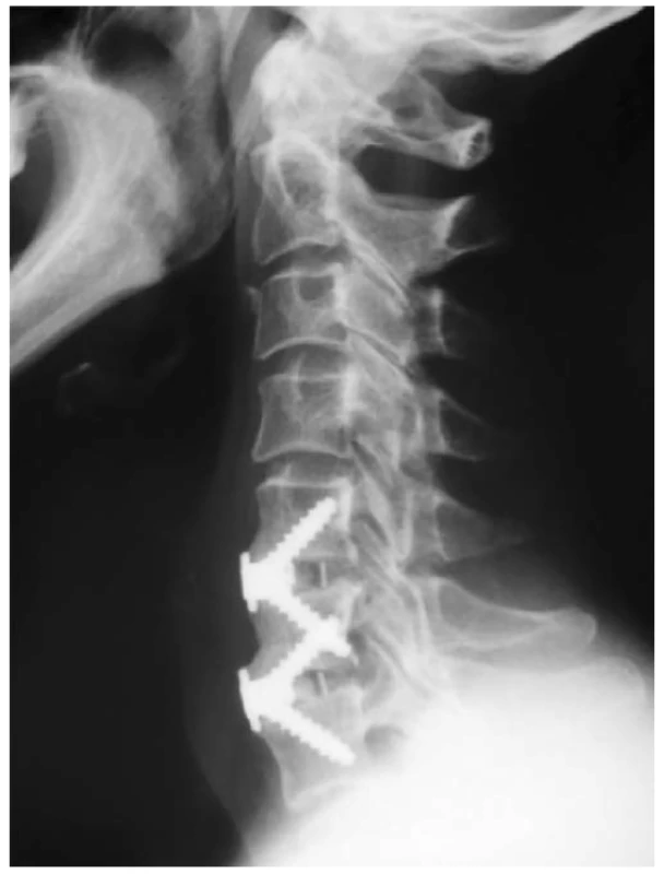 X-ray image after implantation of Zero Profi le VA cage
in levels C5-6, C6-7