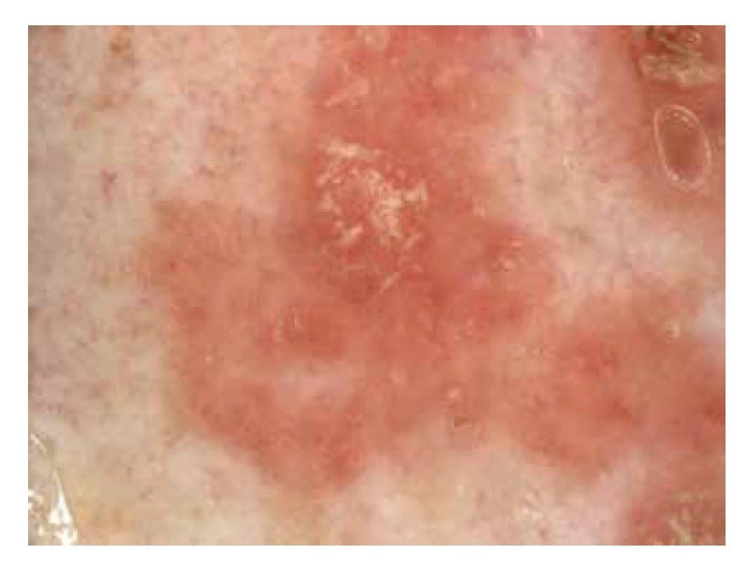 Dermatoskopie morbus Bowen