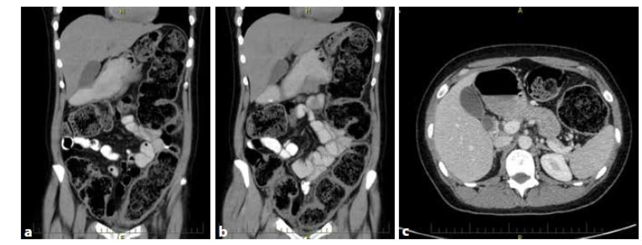 a,b,c: CT nález. Vyšetření provedeno k ověření, že se jedná o ileus. Jeho příčinou byl stenotický nádor c. sigmoideum<br>
Fig. 2a,b,c: CT finding. CT performed to verify obstruction. The obstruction resulted from stenotic sigmoid cancer