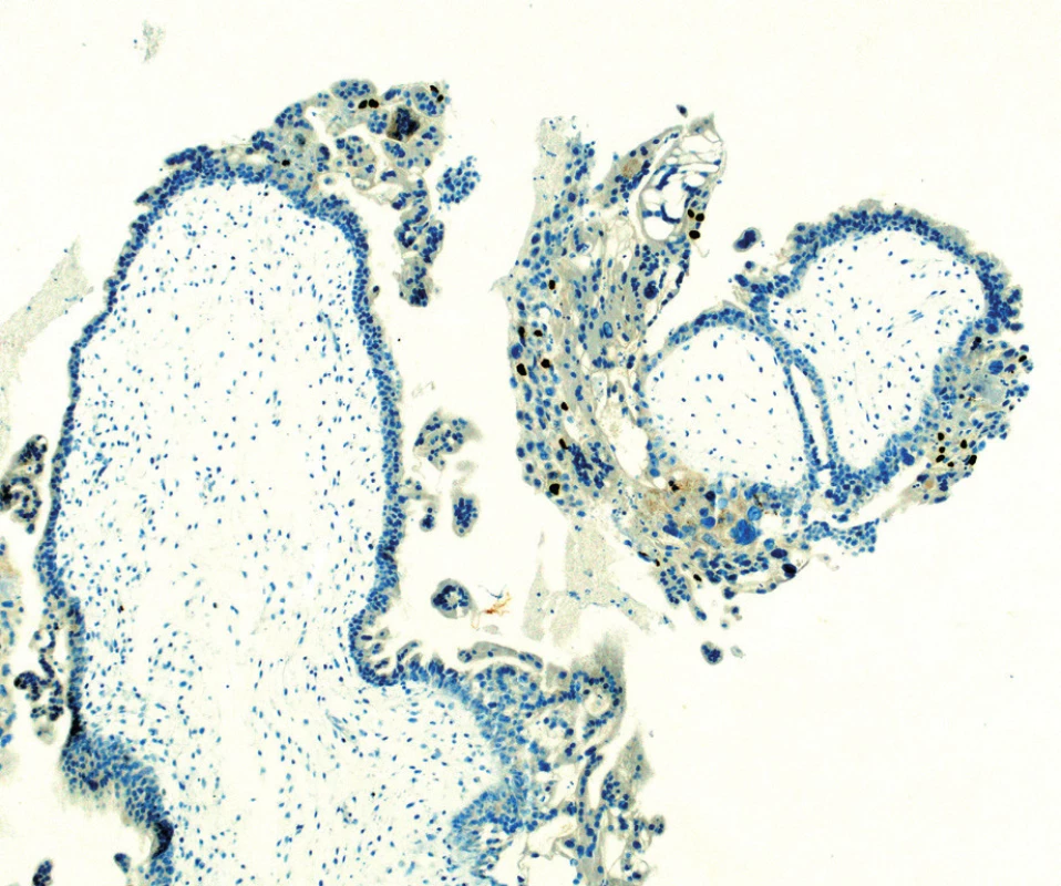 Histologický preparát – imumunochistochemie p57<br>
Kompletní mola hydatidosa. Vilózní cytotrofoblast a buňky
stromatu jsou negativní na imunohistochemii p57. Intermediální
trofoblast slouží jako vnitřní pozitivní kontrola.