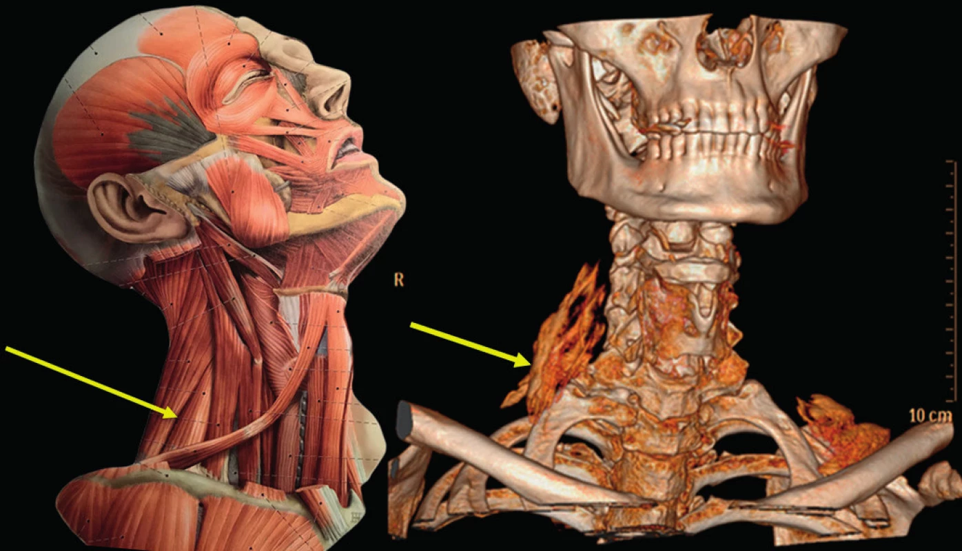 Fasciální prostor pro průběh n. thoracicus longus na krku.
Anatomický obraz a 3D rekonstrukce prostoru mezi m. levator scapulae
a m. scalenus dorsalis