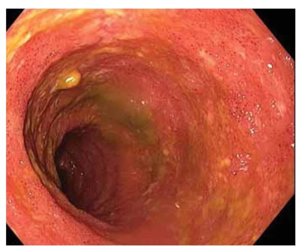 Endoskopie ileálního vaku („pouchoskopie“) a pohled
do přívodné kličky.
Fig. 2. Ileal sac endoscopy (“pouchoscopy”) and a view into
the supply loop.