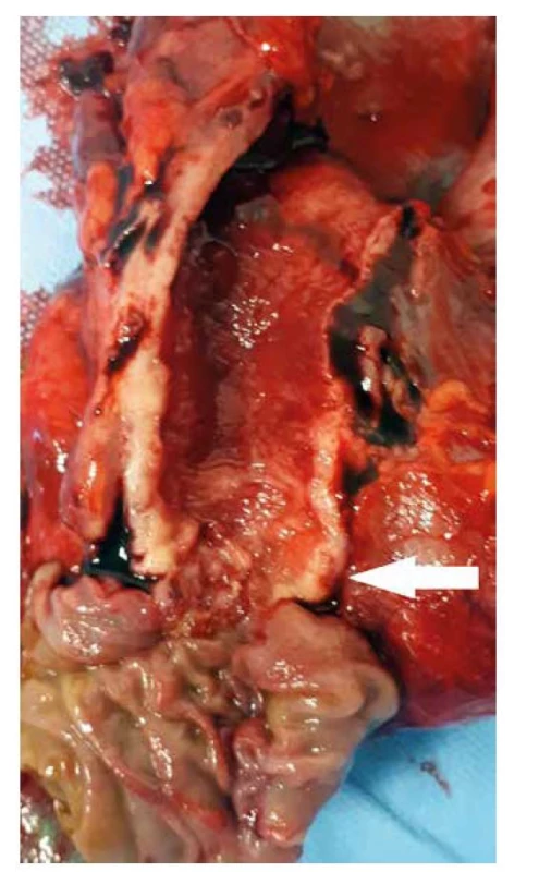 Pravostranná pankreatoduodenektomie, resekát
s cholangiokarcinomem distálního žlučovodu (bílá šipka)<br>
Fig. 1: Pancreatoduodenectomy, specimen with distal
bile duct cholangiocarcinoma (white arrow)
