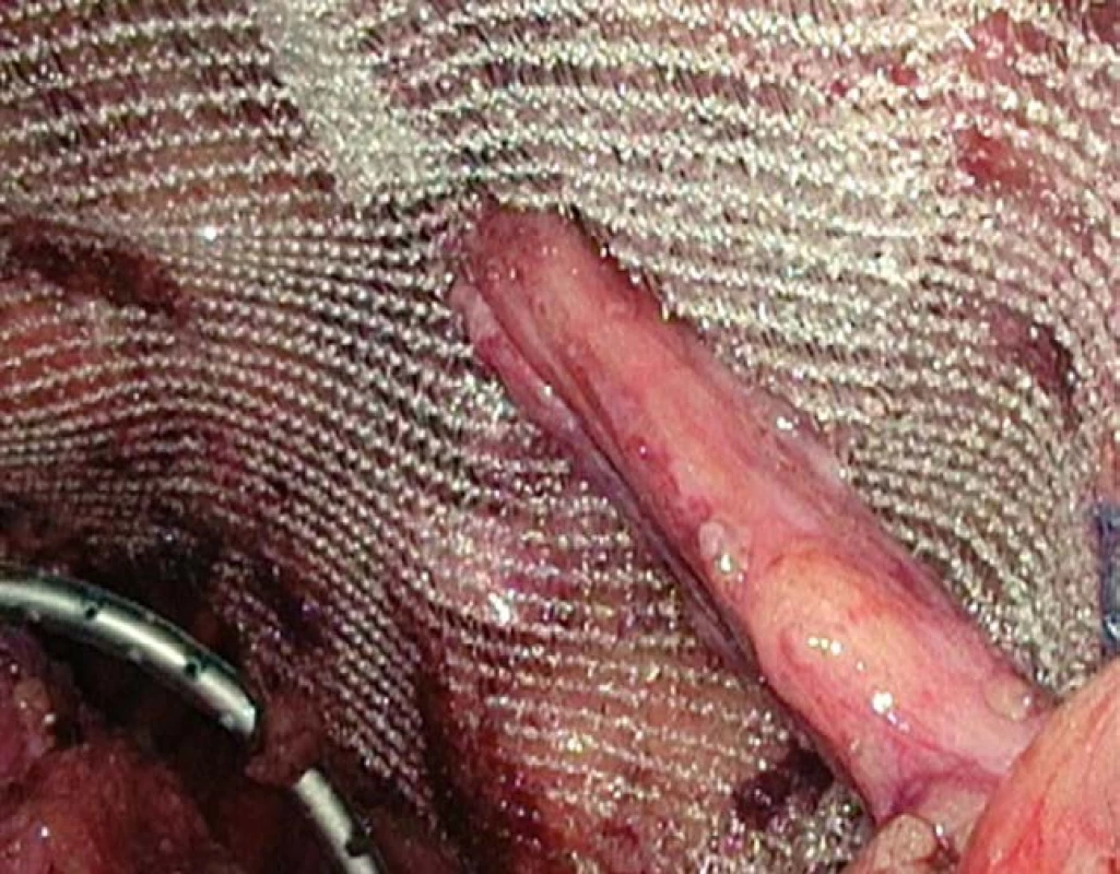 Umístění síťky<br>
Fig. 2. Mesh placement