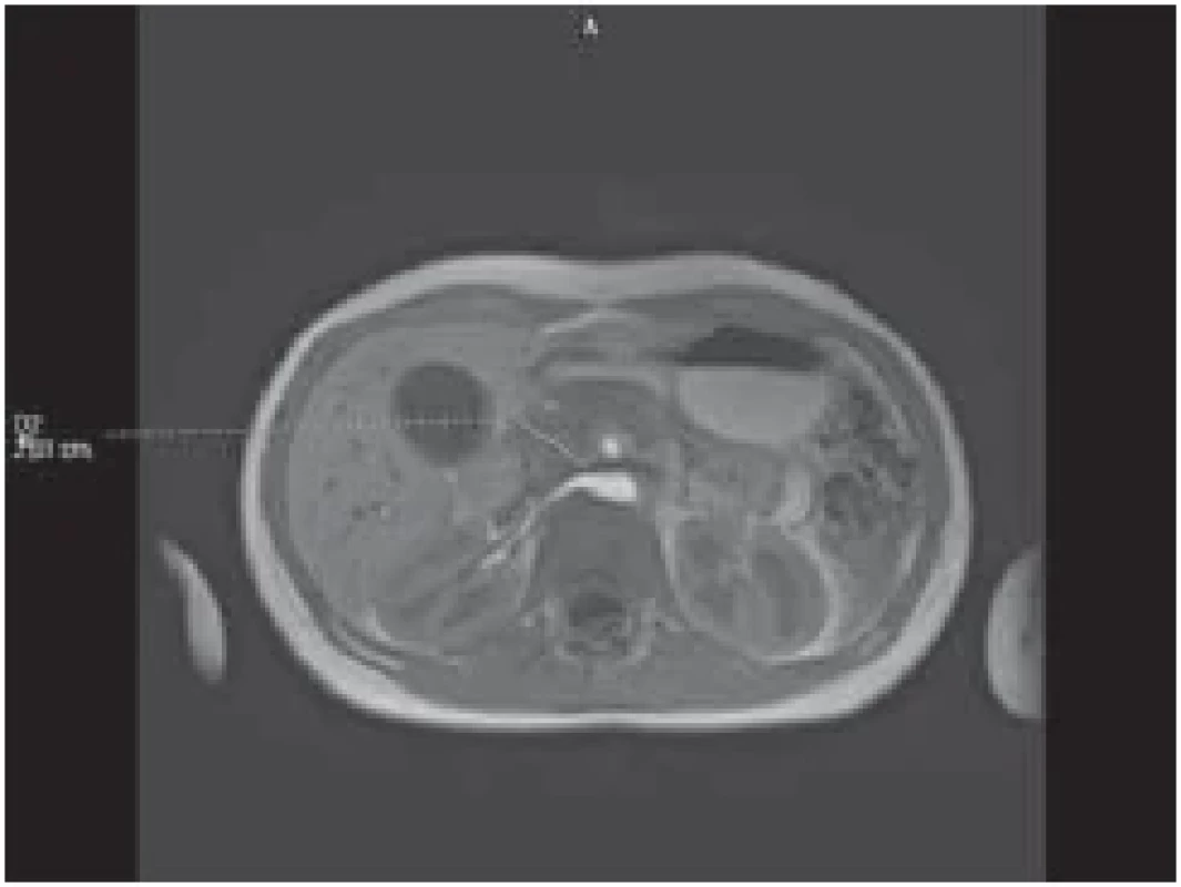Změněný signál a hraniční šíře
hlavy pankreatu na MR v T1 sekvenci. <br> 
Fig. 1. Changed signal and border width of
the pancreatic head on MRI in T􀍷 sequence.