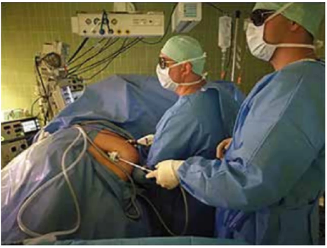 Ruka operatéra zavedená v dutině břišní pacienta
při HALS nefrektomii<br>
Fig. 1: Surgeon´s hand inside the patient´s abdominal cavity during HALS nephrectomy