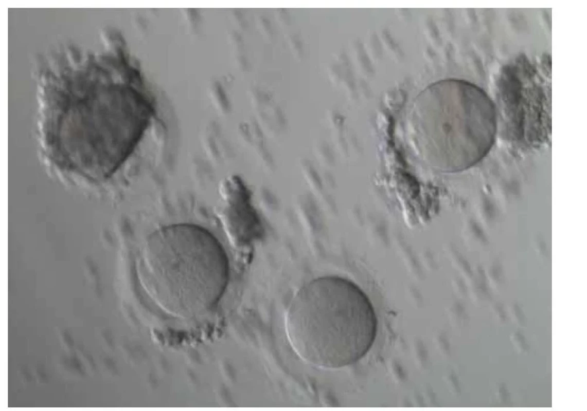 Mikroskopicky nalezené oocyty po aspiraci z antrálních folikulů z kortexu
ovaria.<br>
Fig. 2. Microscopically found oocytes after aspiration of antral follicles from the
ovarian cortex.