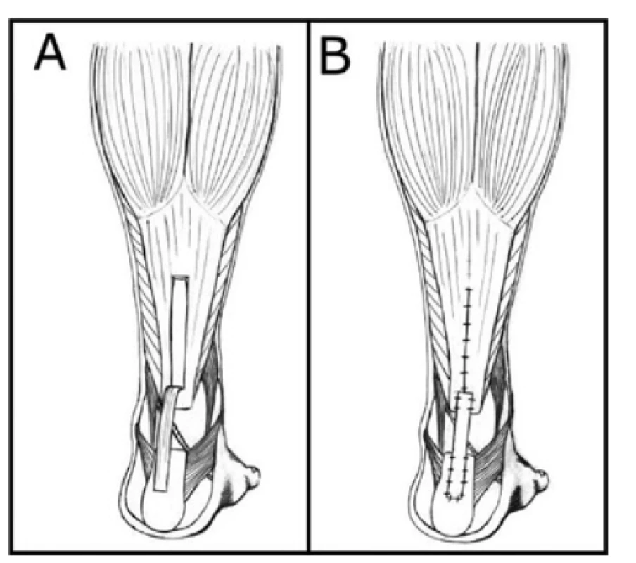 Metody rekonstrukcí defektů Achillovy šlachy:
technika podle Silfverskiölda − A – příprava, B – dokončení<br>
Fig. 4: Methods of Achilles tendon reconstruction: Silfverskiöld
technique − A – preparation, B – completion
