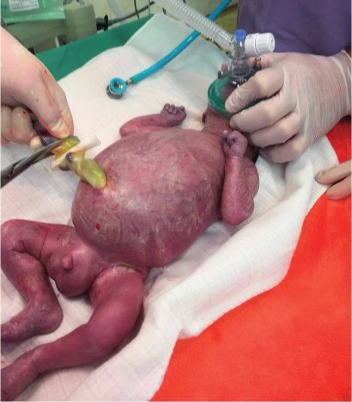 Bezprostřední poporodní nález, výrazný ascites,
hydrotestes, cyanóza