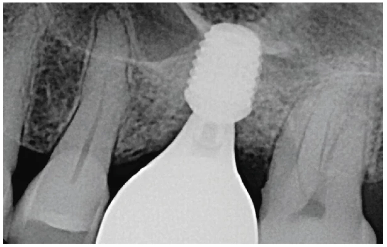 Kontrolní RTG snímek tři
roky po implantaci krátkého
implantátu nevykazuje žádné
změny alveolárního výběžku
v těsné blízkosti krátkého
implantátu <br> 
Fig. 7 Three-years post-op
radiograph showing no
changes of the alveolar process
in the close proximity to the
short implant