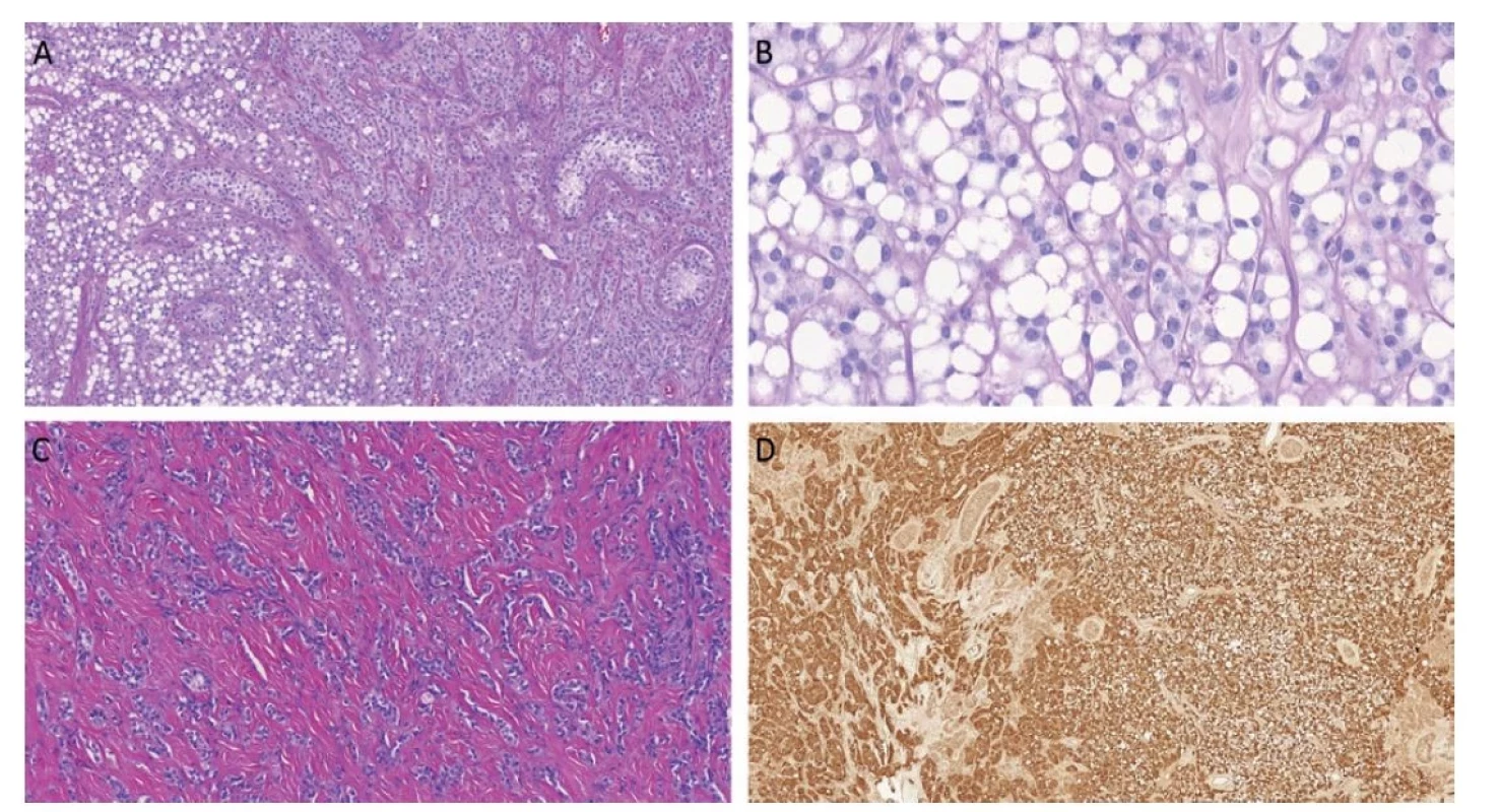 Stromální nádor z prstenčitých buněk je histologicky složen z prstenčitých či eozinofilních buněk. Existují nádory s čistě prstenčitou či
eozinofilní morfologií. Často lze však zastihnout obě komponenty v jednom tumoru (A). Prstenčité buňky jsou blandní, cytoplazmatická vakuola
je prázdná, neobsahuje mucin ani jiné substance (B). Tumory mají variabilní množství fibrózního stromatu, v některých případech stromální složka
tumoru dominuje (C). Imunohistochemicky jsou tyto tumory konzistentně nukleárně pozitivní v reakci s beta-cateninem.