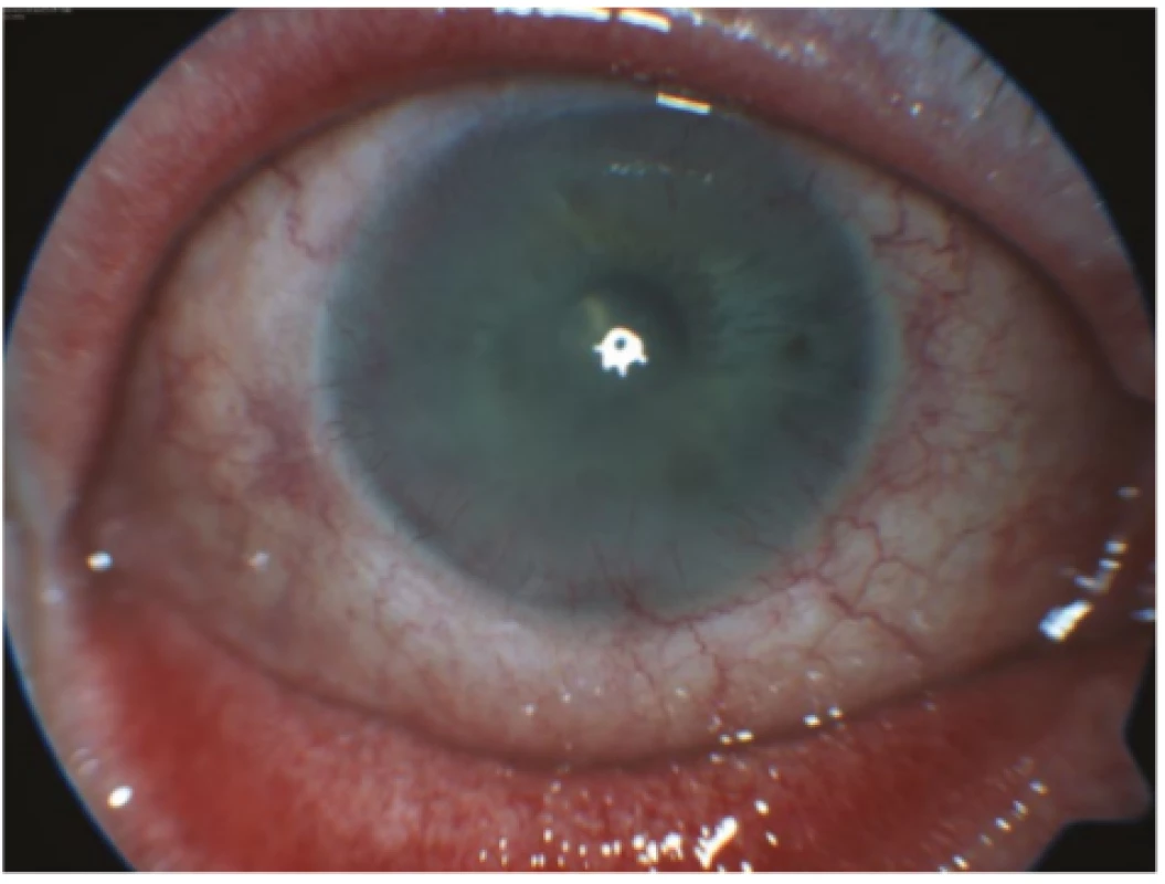  Right eye of patient from case report 2 with mixed
injection of conjunctiva, semitransparent cornea and peripheral limbal superficial and deep corneal vascularisation