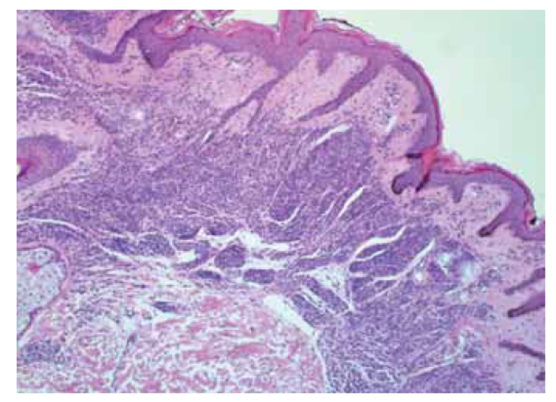 Intradermální melanocytární névus.<br>
Fig. 1. Intradermal melanocytic nevus.