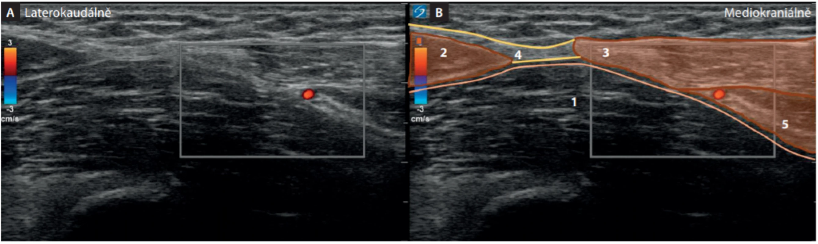 Ultrazvukový obraz inquinální krajiny (obraz uvázaného „motýlka“). Sonda přiložena kolmo na průběh ligamentum inquinale. 1. m. iliopsoas,
2. m. sartorius, 3. m. obliquus externus, 4. ligamentum inquinale, 5. m. obliquus internus