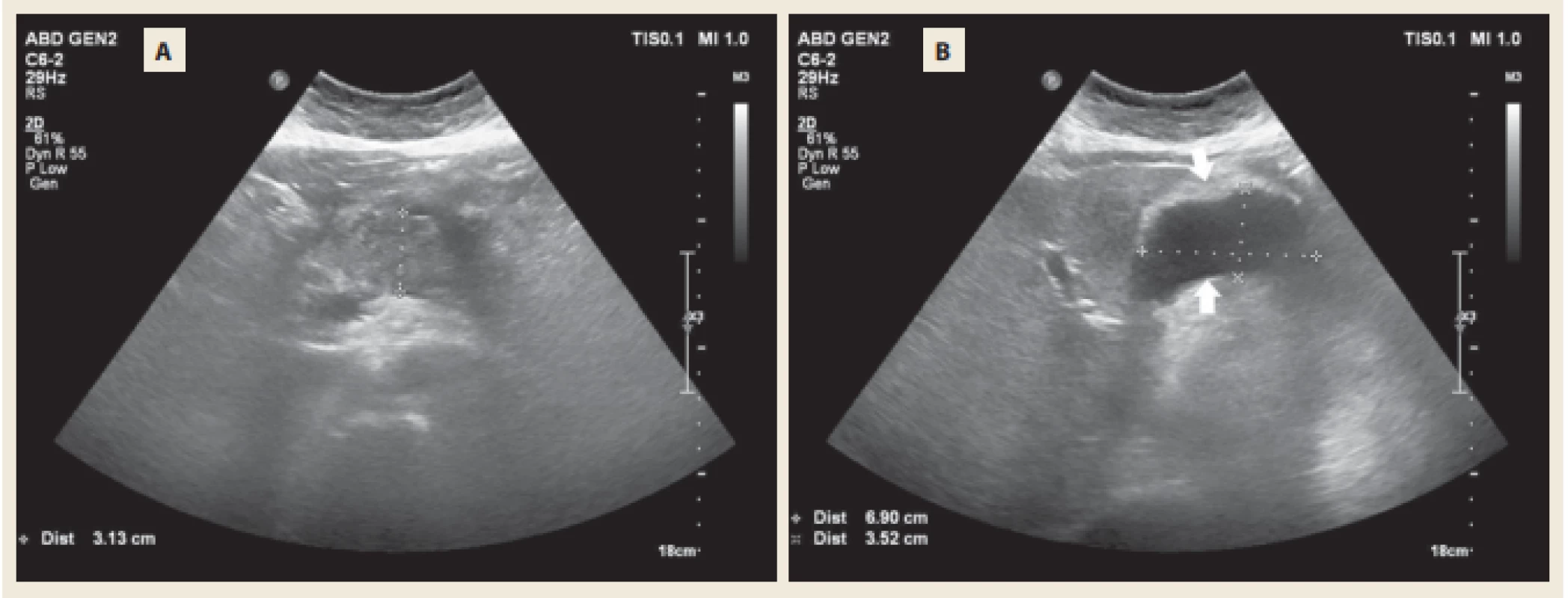 Abdominální UZ s odstupem týdne s nehomogenním zbytněním těla pankreatu (A) a tekutinovou kolekcí mezi 
pankreatem a zadní stěnou žaludku (B). <br>
Fig. 2. Abdomminal ultrasound after 1 week with nonhomogenous exuberance of the pancreatic body (A) and fl uid collection 
inbetween the pancreas and the posterior wall of the stomach (B). 