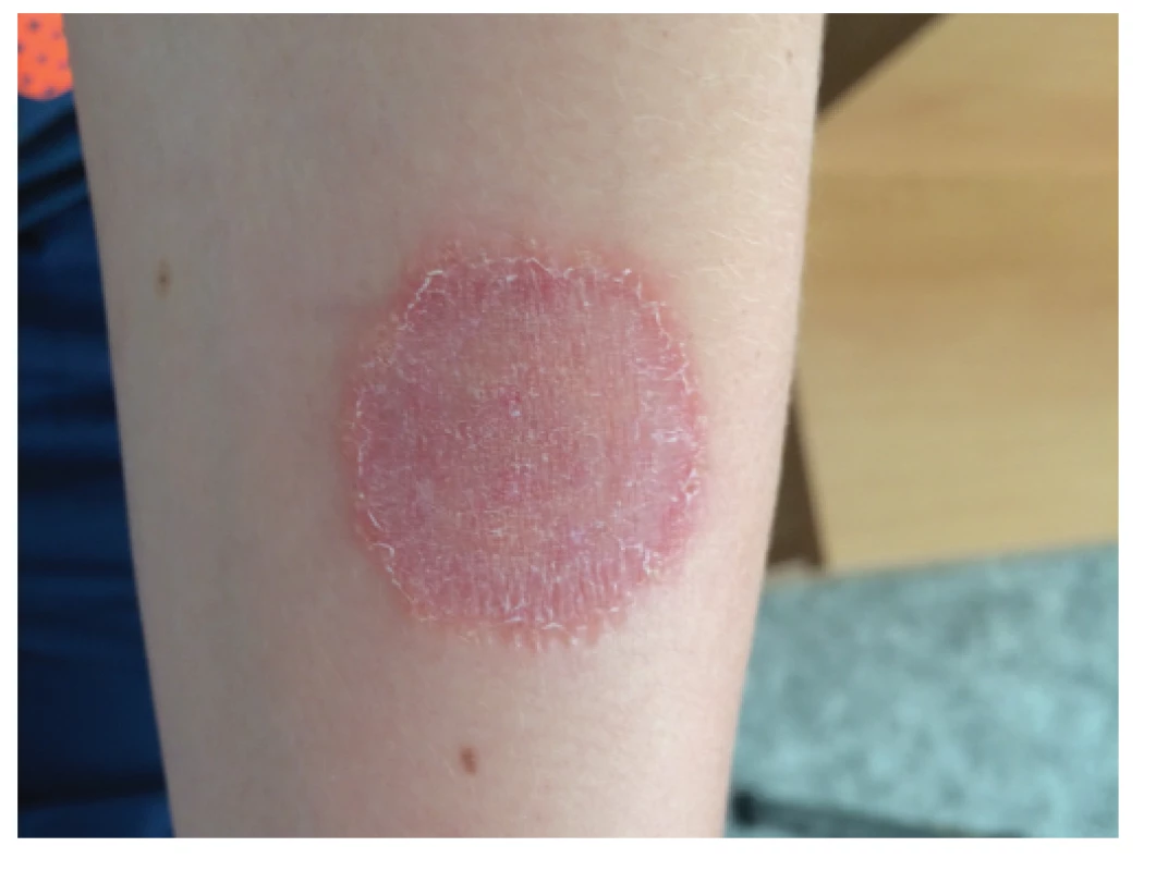 Tinea corporis na levém předloktí třetího pacienta –
červenofialové šupící se ložisko pokryté papulkami