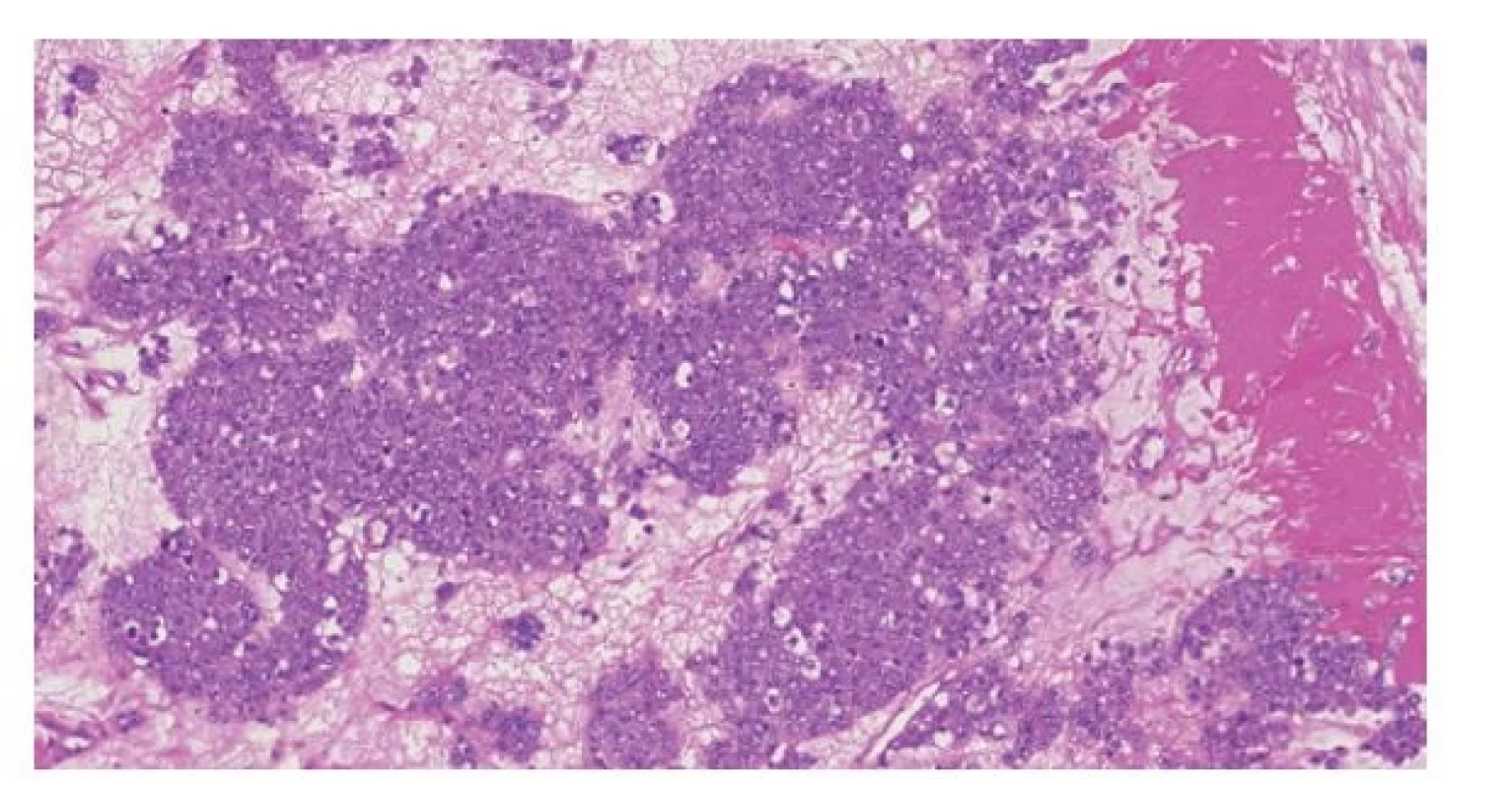 Anaplastický spermatocytický tumor. Histologicky jde o tumor uniformního
vzhledu, což je dáno přítomností pouze intermediárního typu buněk
(klasický spermatocytický tumor je charakterizován nádorovými buňkami
třech velikostí).