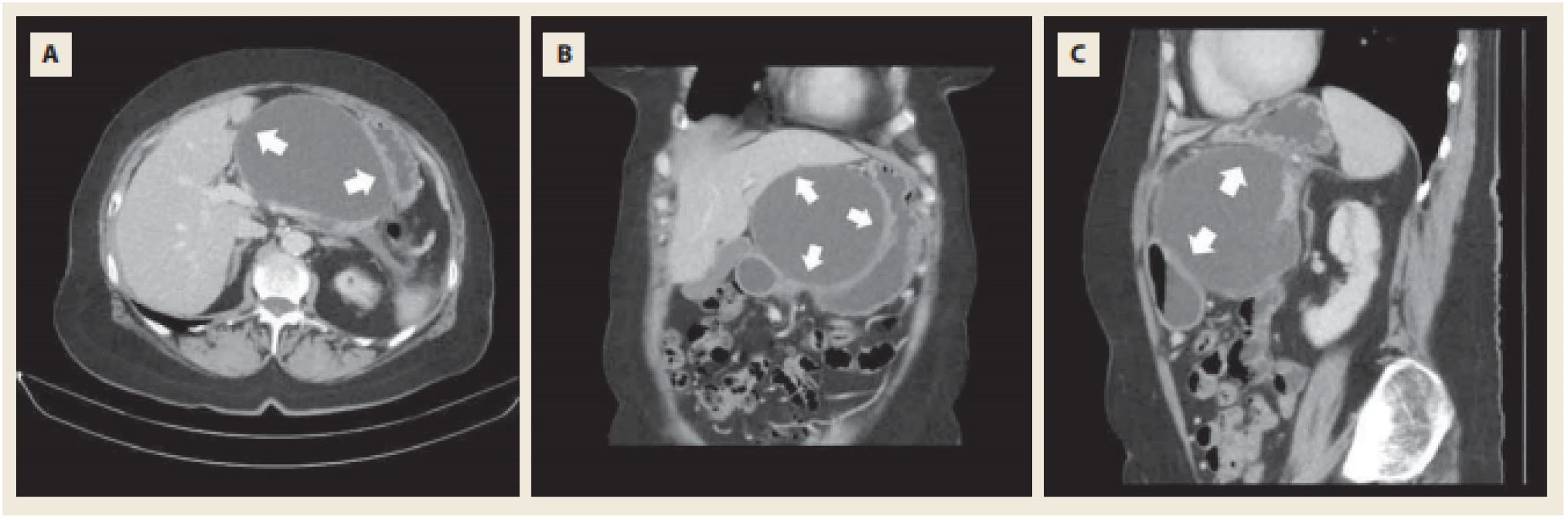 Kontrolní CT s kontrastem. Progrese dobře ohraničené pseudocysty s útlakem zadní stěny žaludku a levého jaterního laloku (šipky). <br>
Fig. 4. Control CT scan with i.v. contrast. Progression of walled-off pseudocyst with compression of posterior wall of stomach 
and left liver lobe (arrows). 