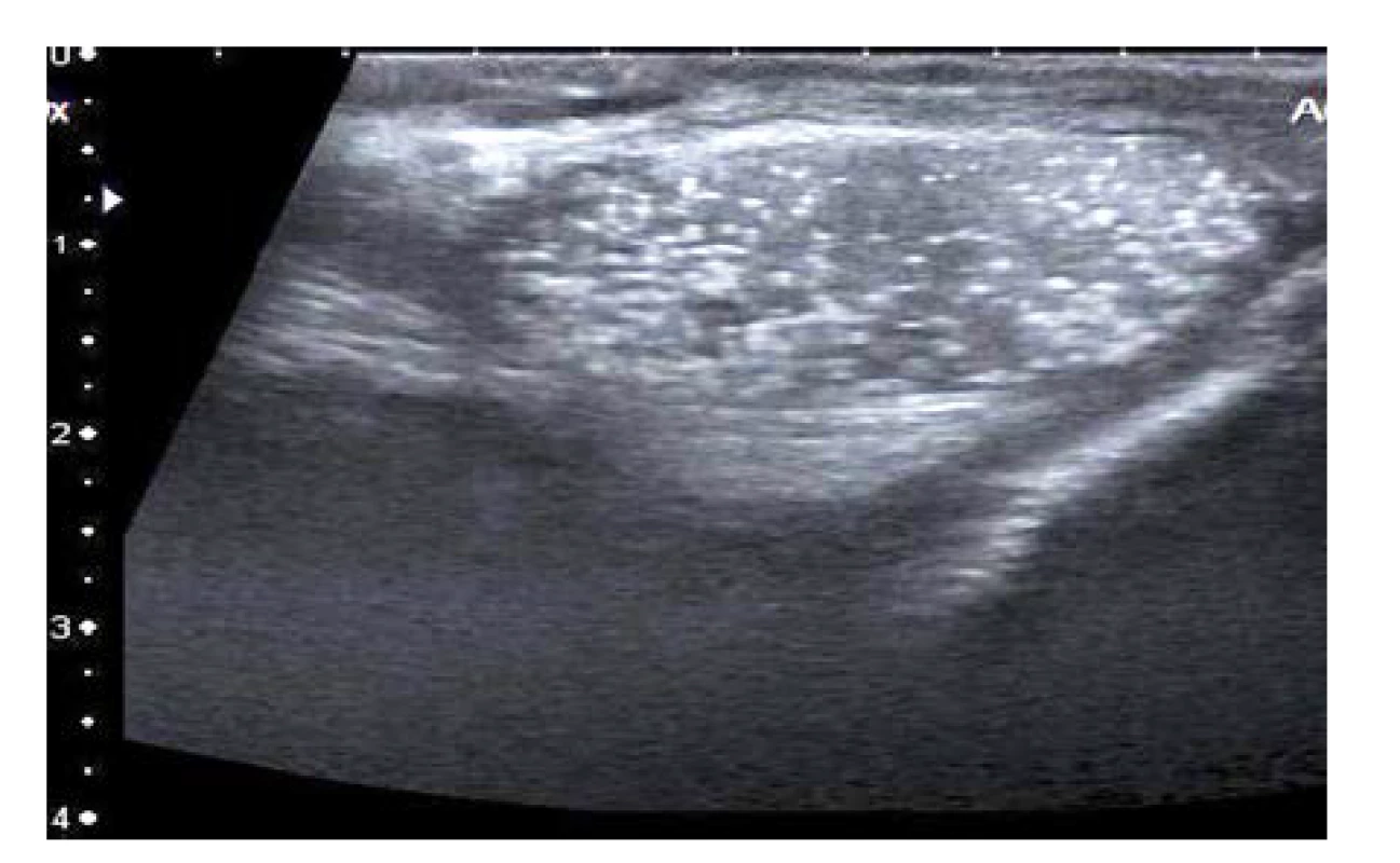 Ultrasonografický nález varlete postiženého
mikrolitiázou<br>
Fig. 1. The ultrasonographic image of testicular
microlithiasis