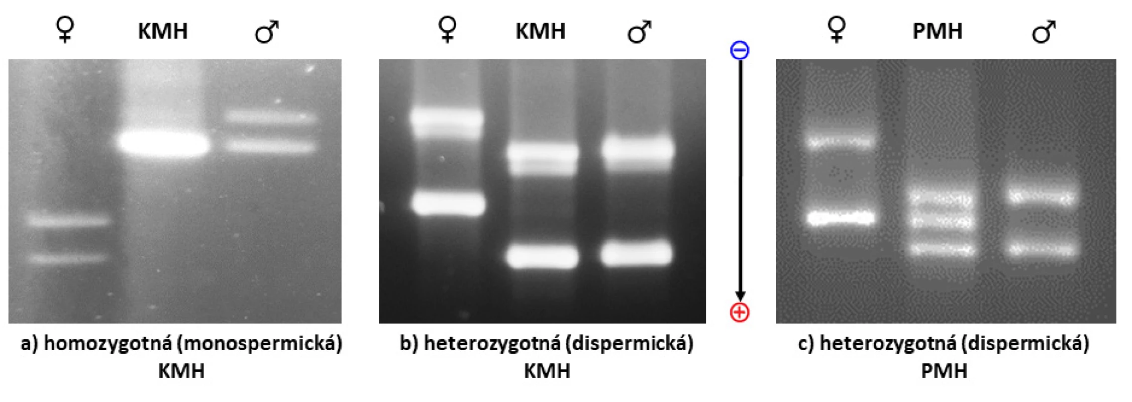 Analýza umožní porovnať profily DNA matky, DNA choriových klkov a prípadne aj DNA otca (KMH - kompletná mola hydatidóza,
PMH - parciálna mola hydatidóza)