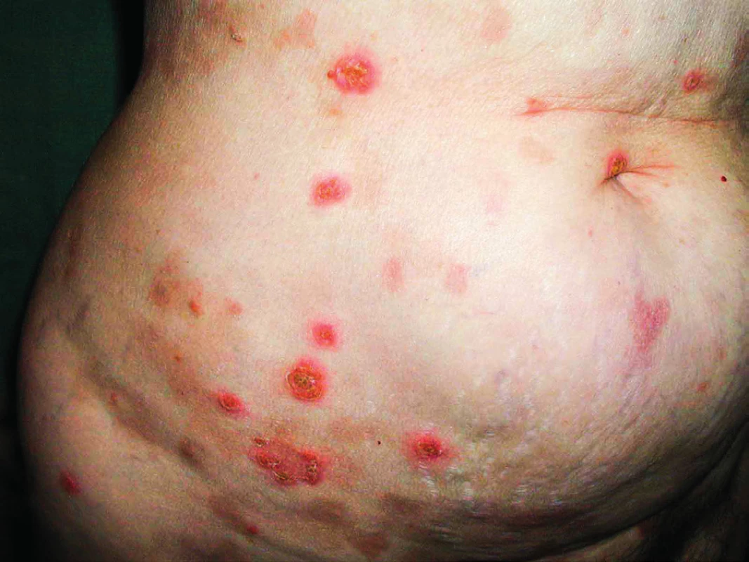 Kožní puchýřnaté onemocnění IgA pemfigus u pacientky
s mnohočetným myelomem