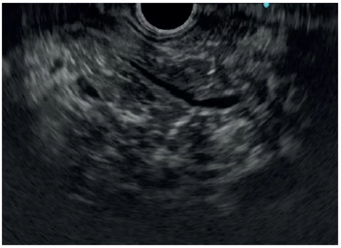 Endoscopic ultrasound confirming absence of any
stone or stricture in the main pancreatic duct