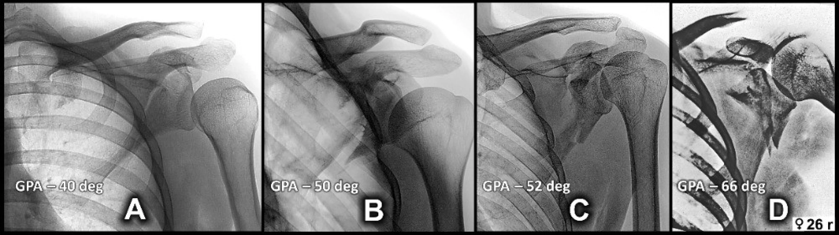 Comparison of the degree of displacement of the glenoid fragment, showing an increasing valgosity and widening
of a gap between the coracoid and the glenoid fragment. A – case 2; B – case 3; C – case 4, D – case 1