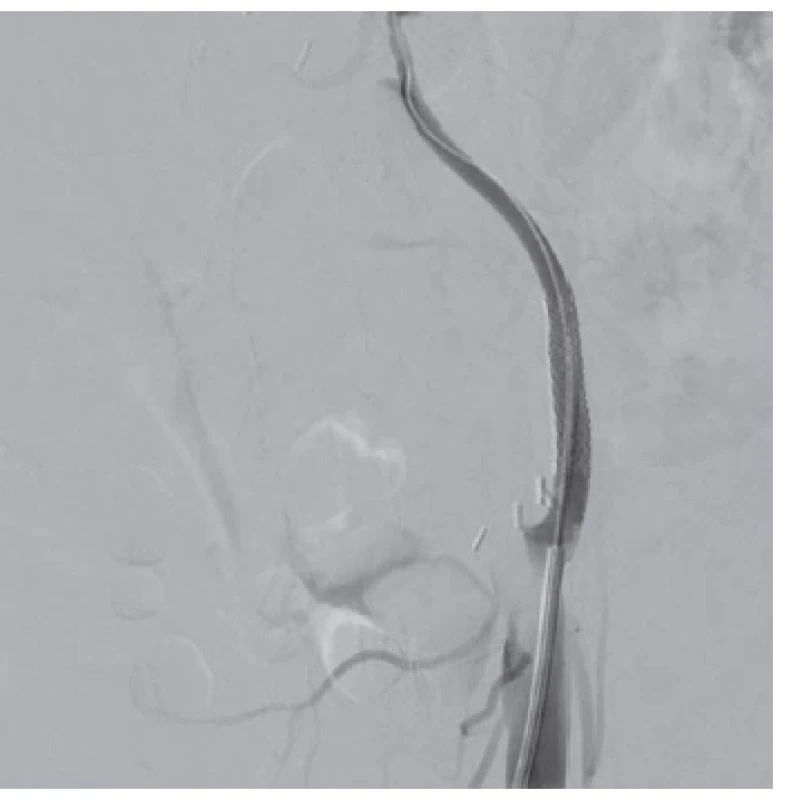 DSA po trombolýze – pečeň je perfundovaná v celom
rozsahu. Zobrazuje sa degenerácia steny bypassu<br>
Fig. 2: DSA after thrombolysis – the liver now has adequate
perfusion. A degeneration of bypass wall is shown